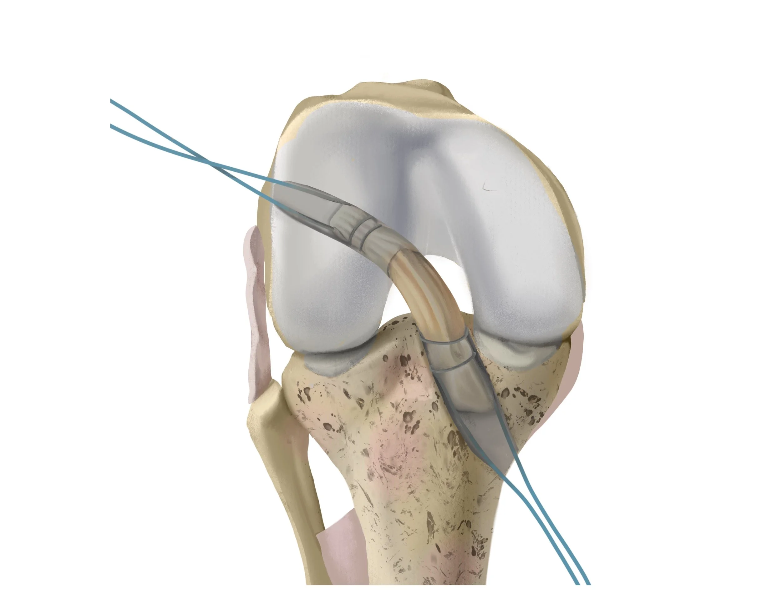 Digital illustration of a knee joint during a medical procedure with surgical tools.