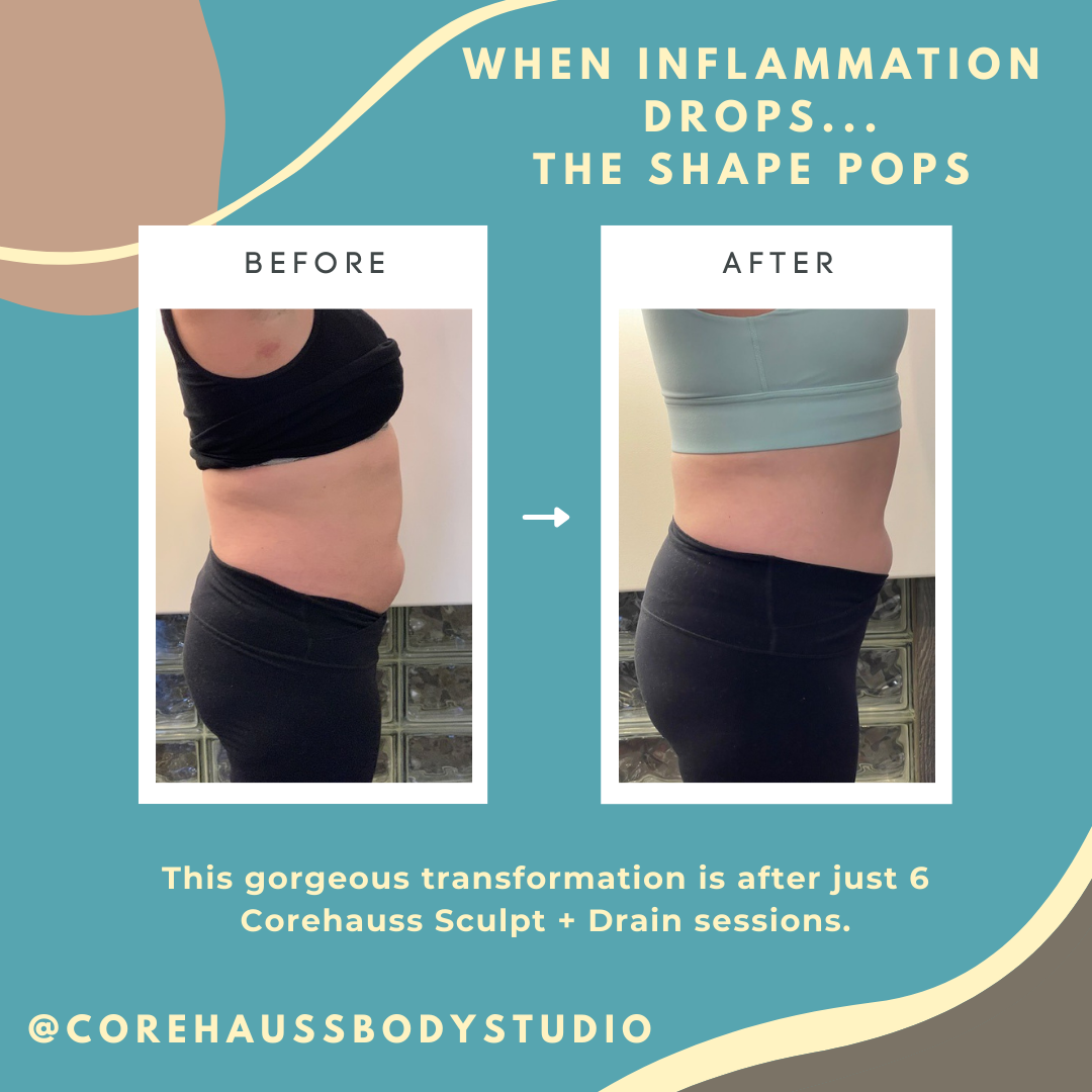 Before and after images showing visible changes following lymphatic and metabolic reset sessions using non-invasive Eurowave technology at Corehauss Body Studio in St. Albert, AB. Individual results vary.