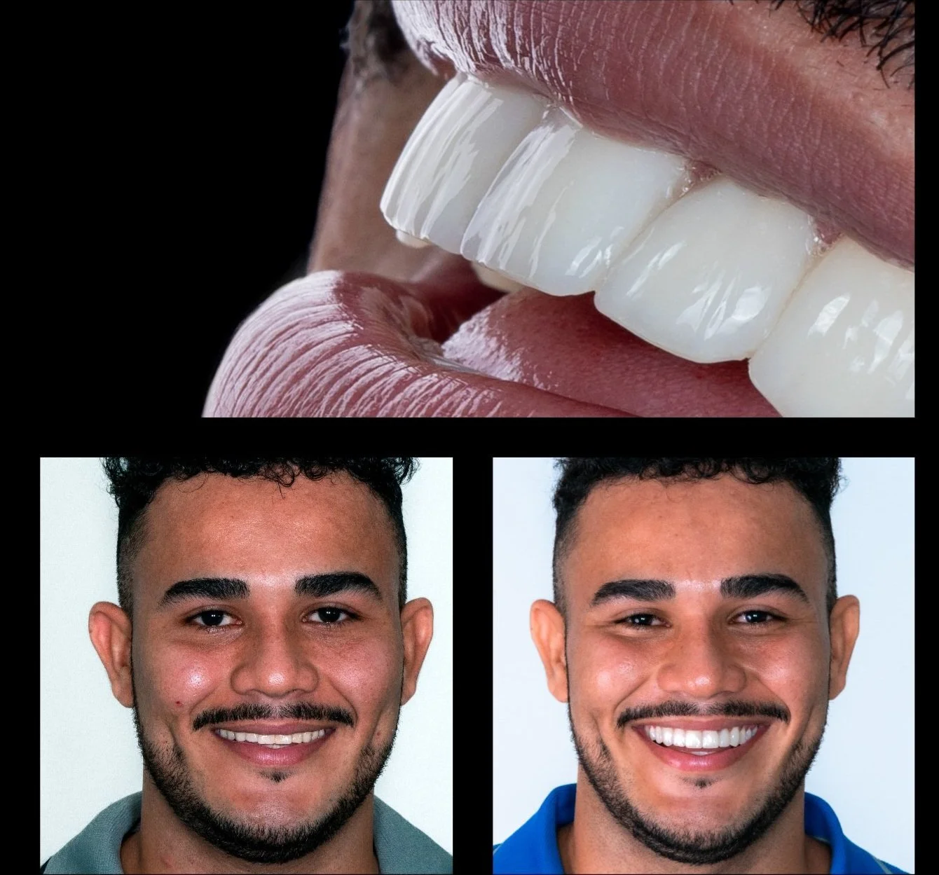 Composite Bonding / Fillings