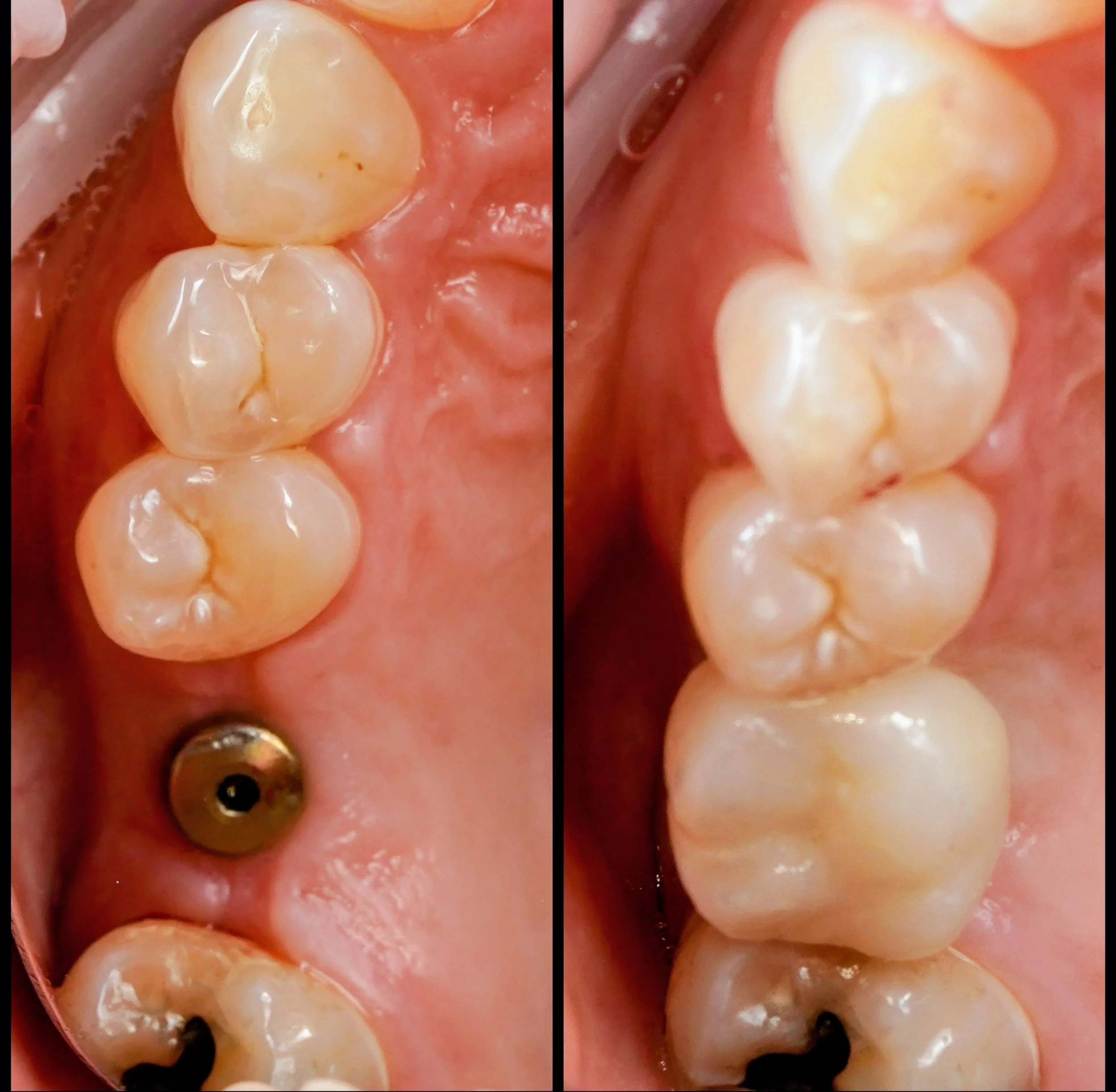 Dental Implants