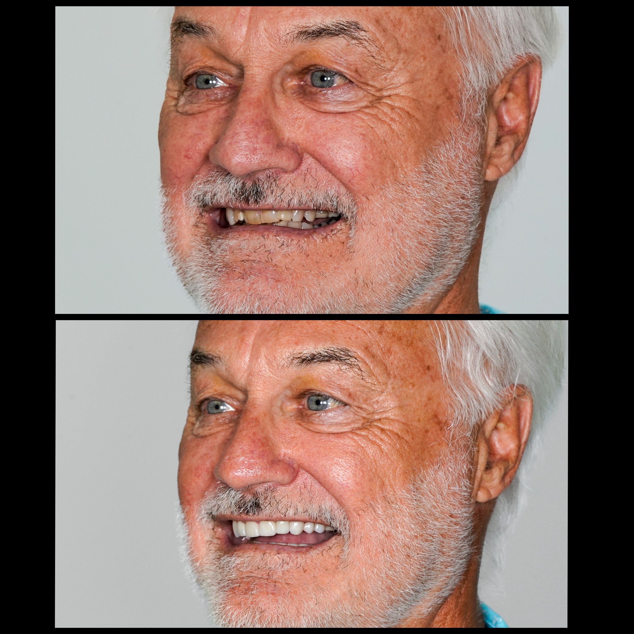 Porcelain Crowns / Veneers