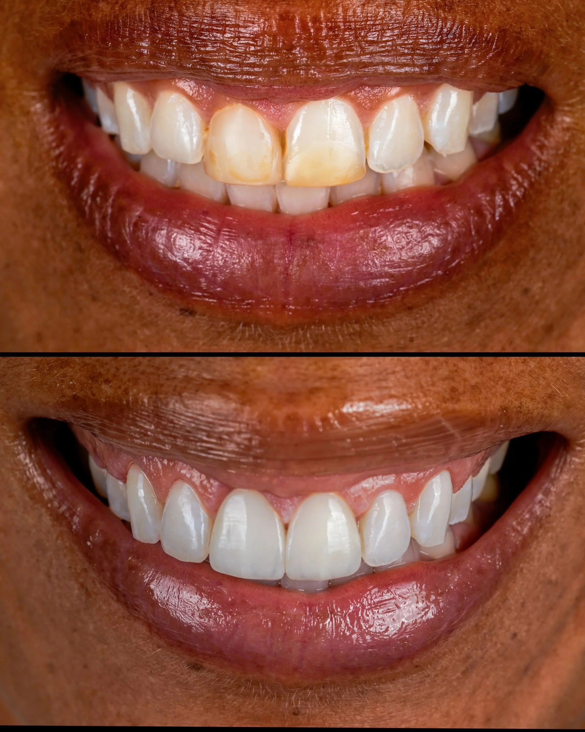 Smile Design (Porcelain Veneers & Crowns)