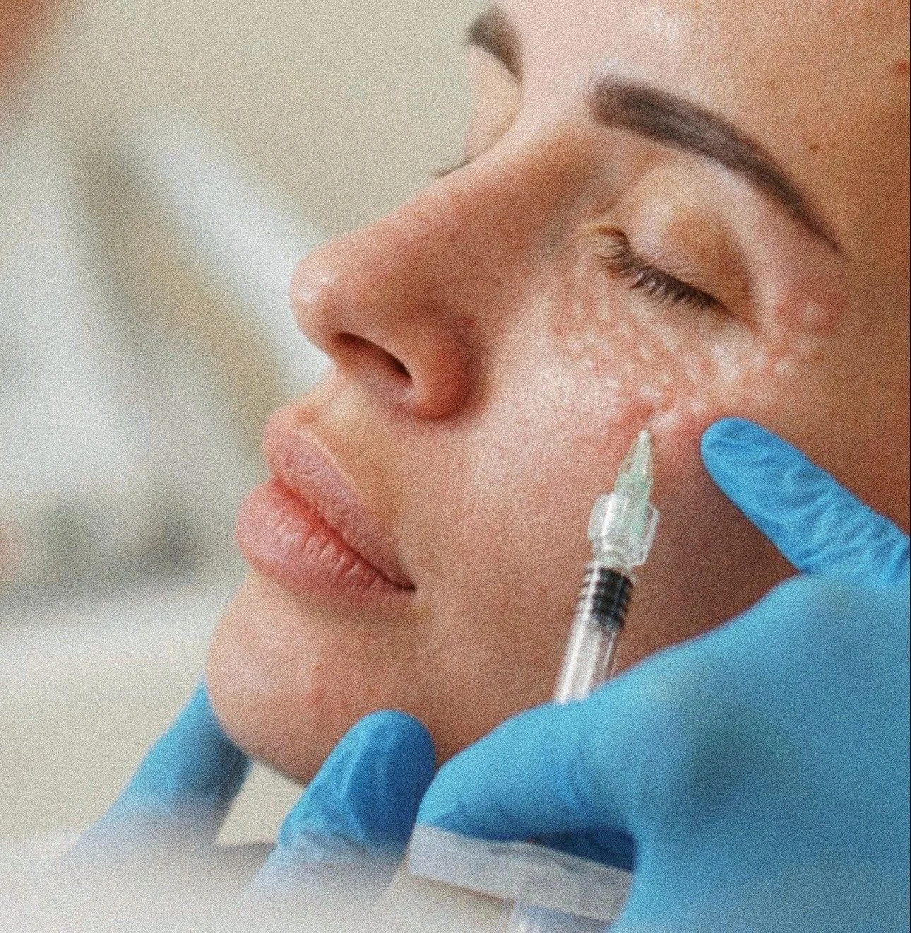 Nainen saa ihonhoitohoitoa lääkäriltä, joka käyttää sinisiä käsineitä.