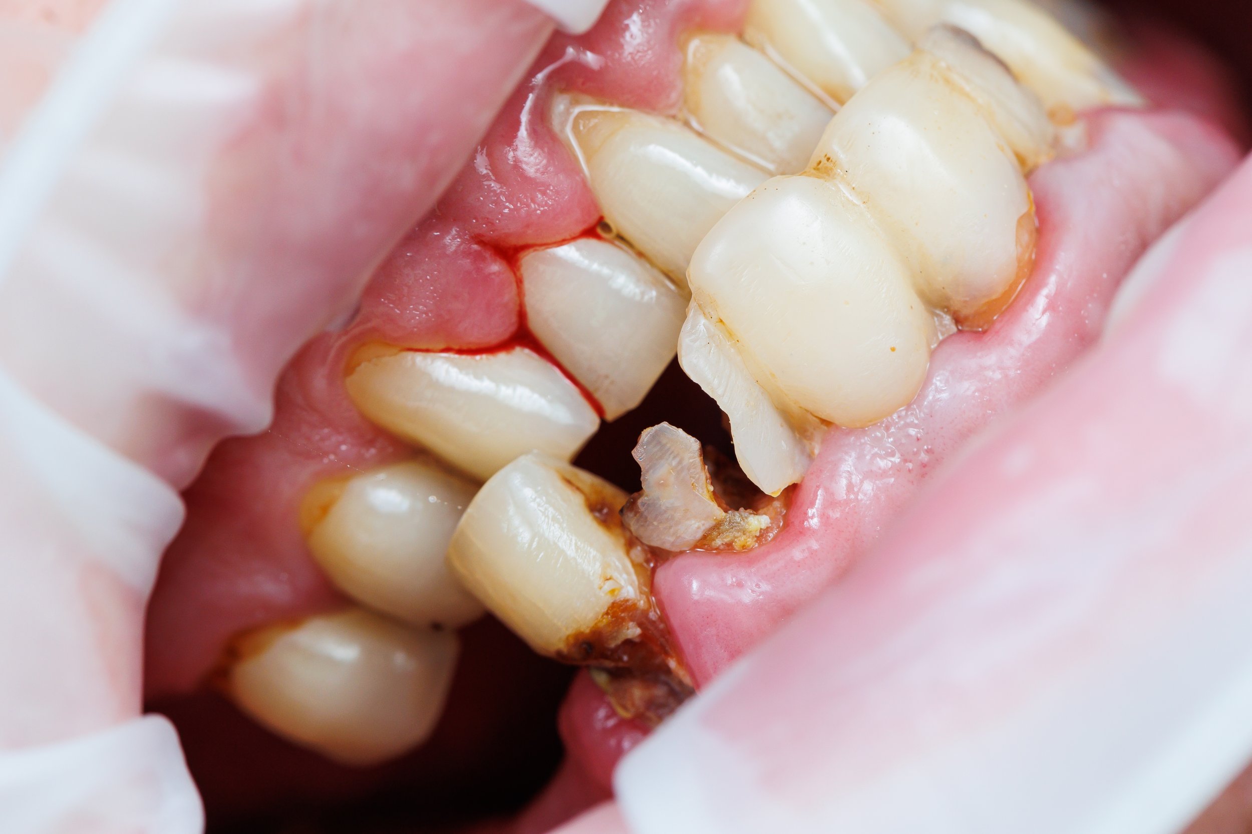 Close-up of teeth with severe decay and cavities, surrounded by pink gums.