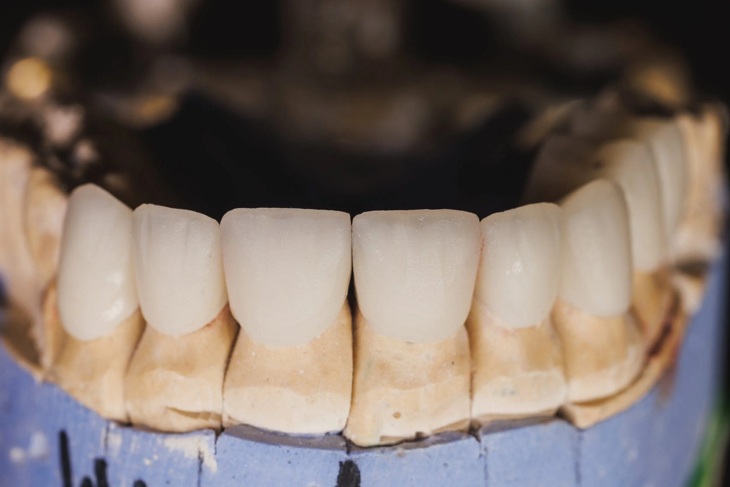 Close-up of a dental cast with artificial teeth, showing the upper teeth set with a framework in the background.