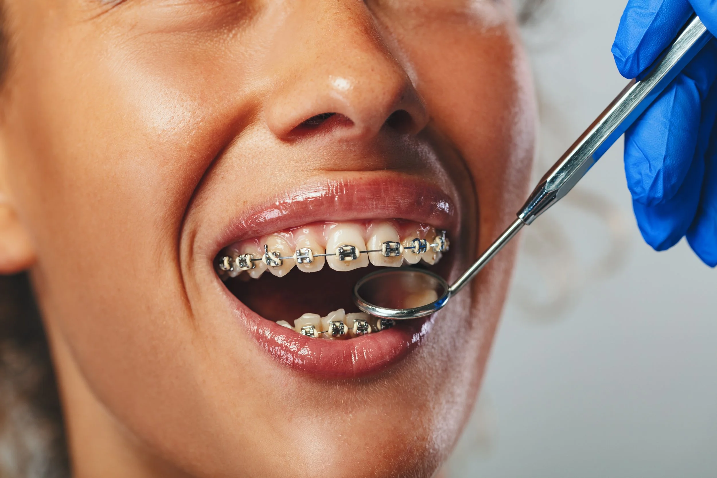 Close-up of a person with braces on their teeth receiving an oral checkup with a dental mirror and a gloved hand holding a dental instrument.