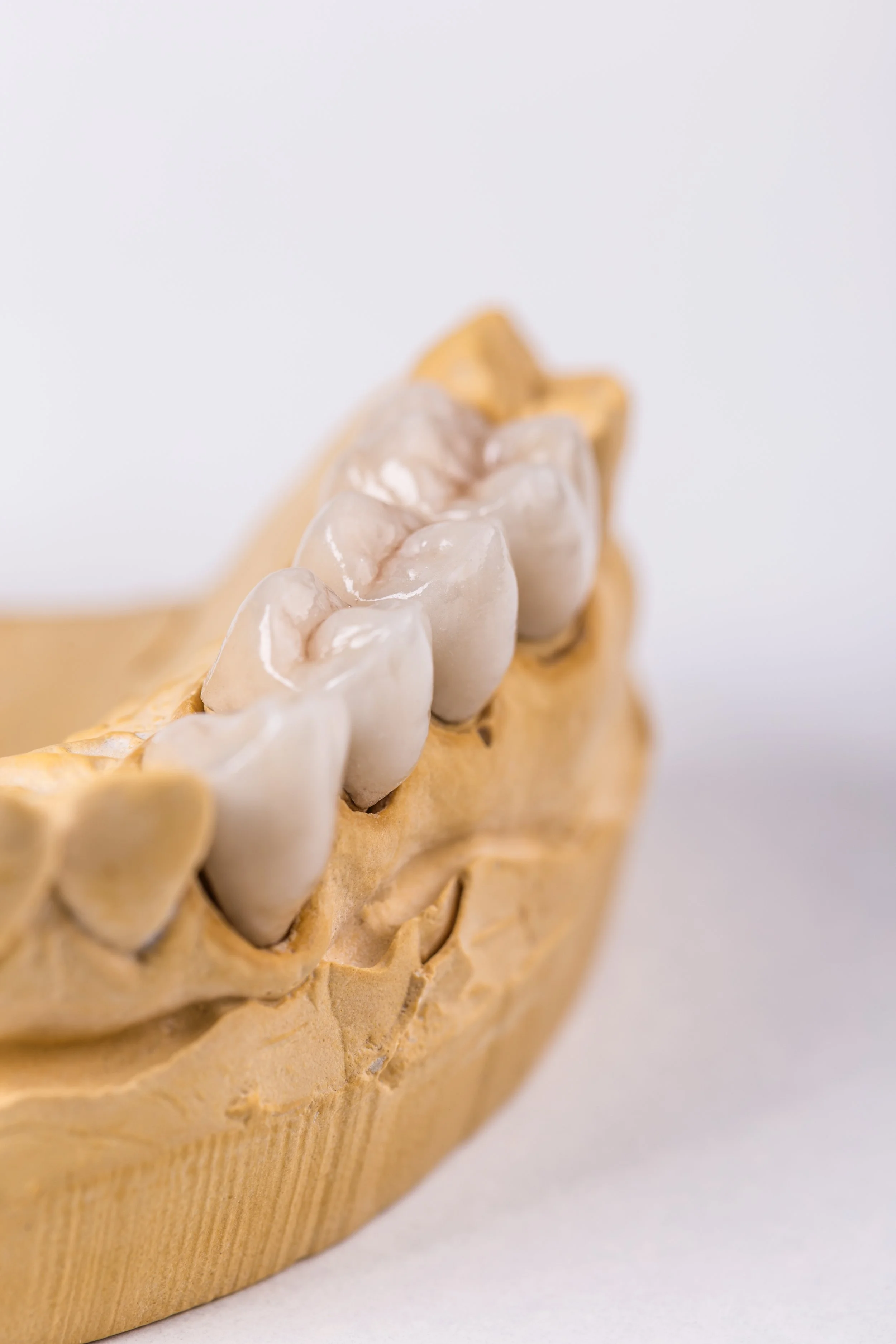 Close-up of a dental model with a row of ceramic dental crowns attached to the gum line, showing the teeth and gum details.