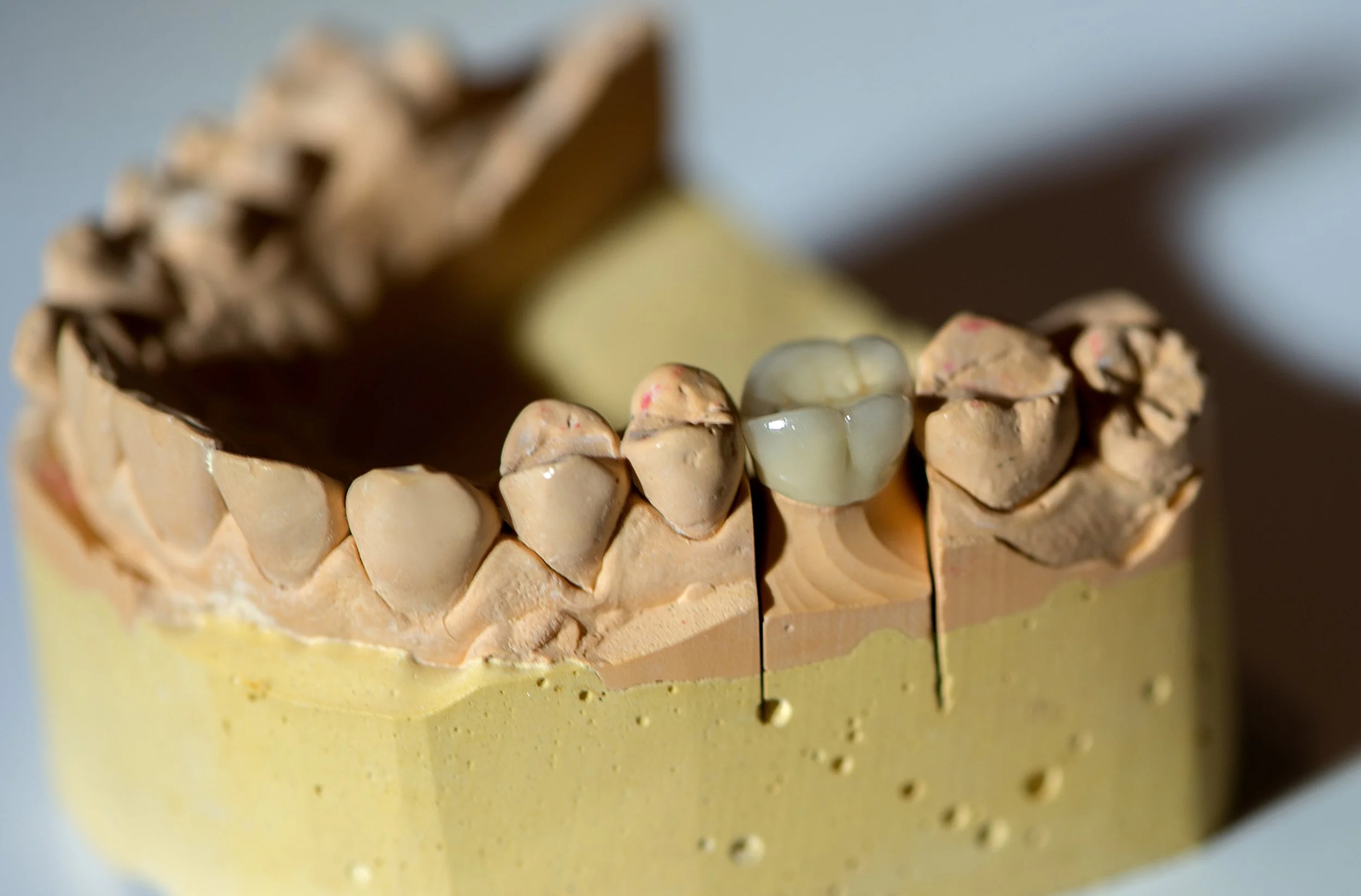 Close-up of a dental model showing teeth, with one tooth made of a different material, possibly a crown or filling.