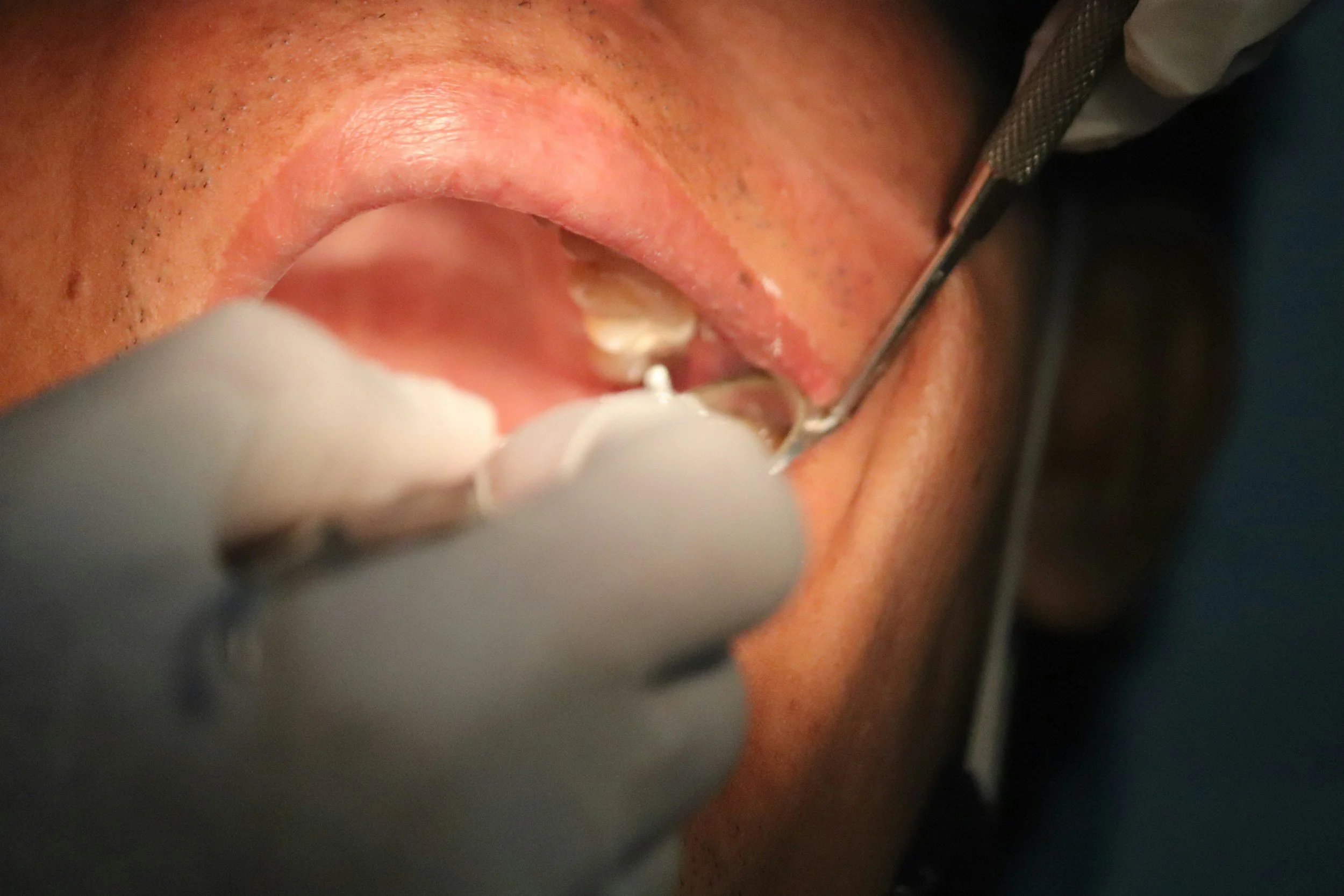 Close-up of a person receiving a dental procedure, with dental tools and a gloved hand visible in the mouth.