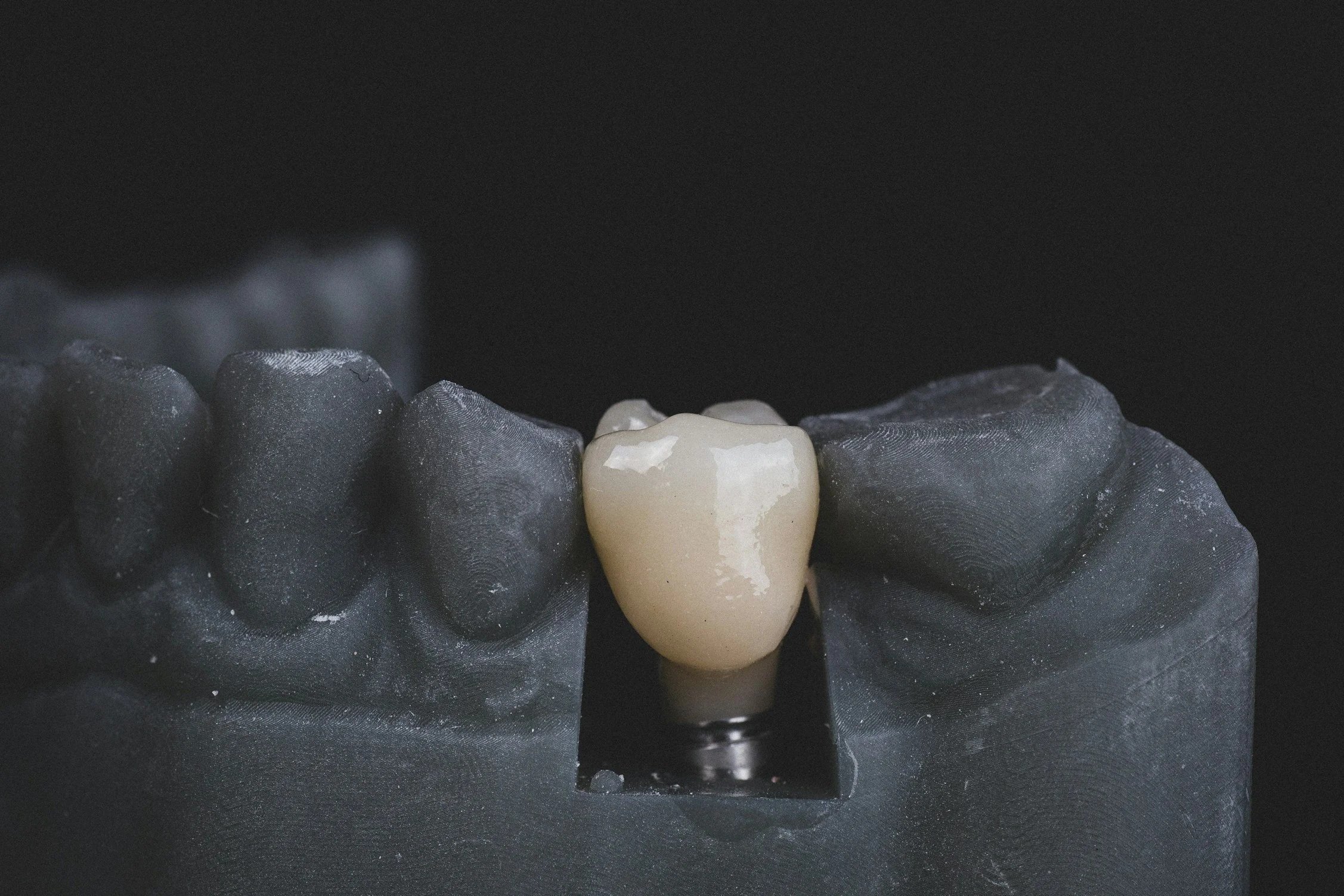 A dental implant with a ceramic crown on a dental model.