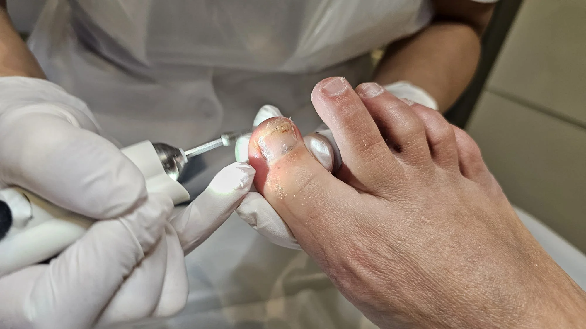 Een medische professional geeft een nagelverzorging of behandeling aan een hand, met gebruik van een instrument en een lampje, bij een patiënt met een beschadigde nagel en een geïnfecteerd uitziende vinger