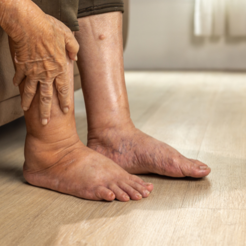 Close-up of a person's swollen, discolored feet and ankles resting on the floor.