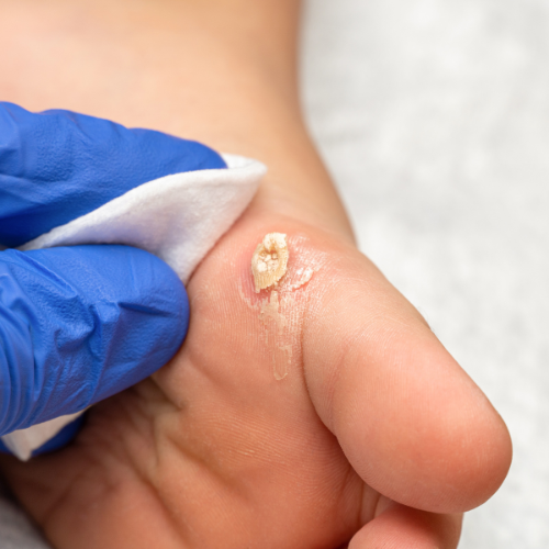 Close-up of a person's thumb with a removal of a large white blister or callus, being cleaned with a cotton swab by a person wearing blue gloves.