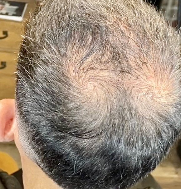 Bald spot before SOLUTION