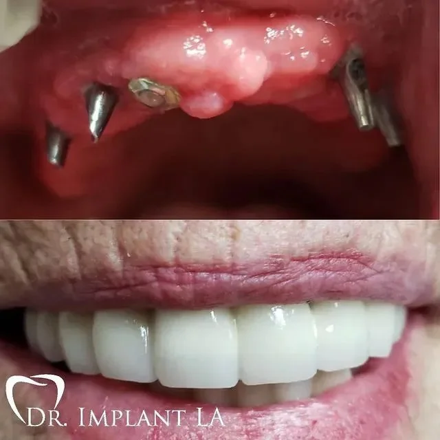 Dental implants before and after comparison showing upper implants and complete set of upper dentures.