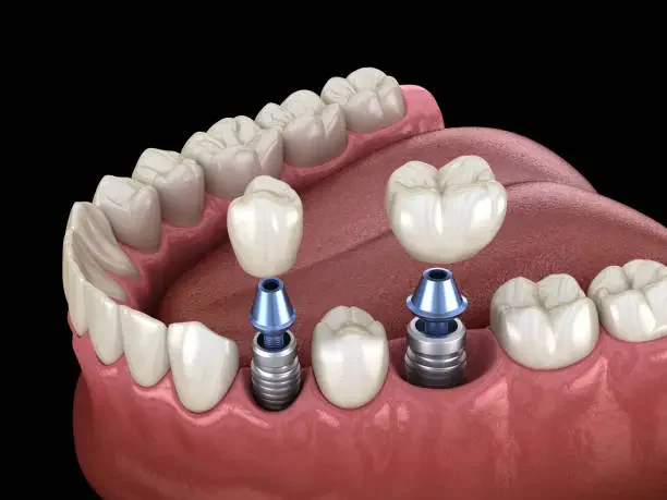 DENTAL IMPLANT 1