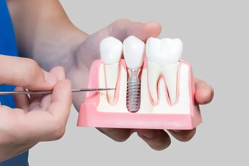 A dental model showing a dental implant with a crown, with a dental instrument pointing at the implant in a person's hand.