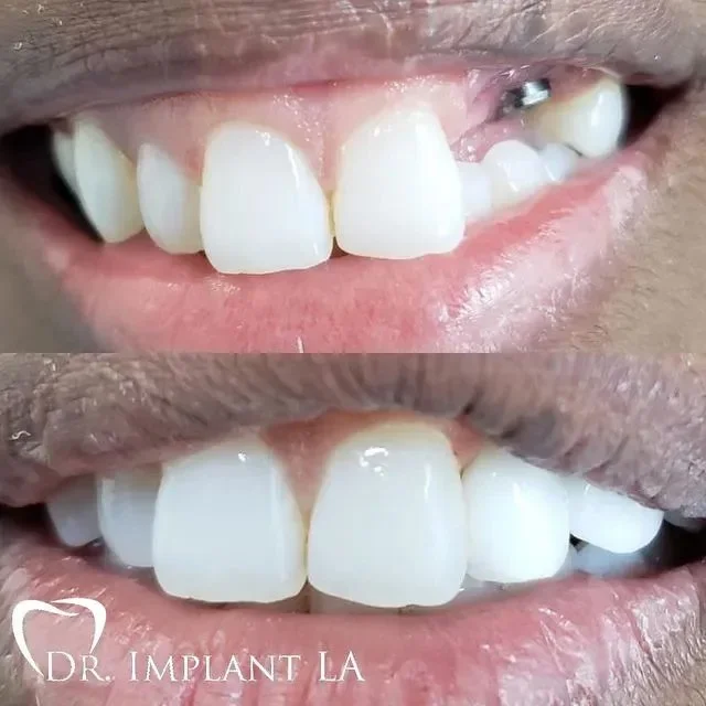Close-up of a person's mouth showing teeth before and after dental implants, with a logo reading 'Dr. Implant LA' in the bottom left corner.