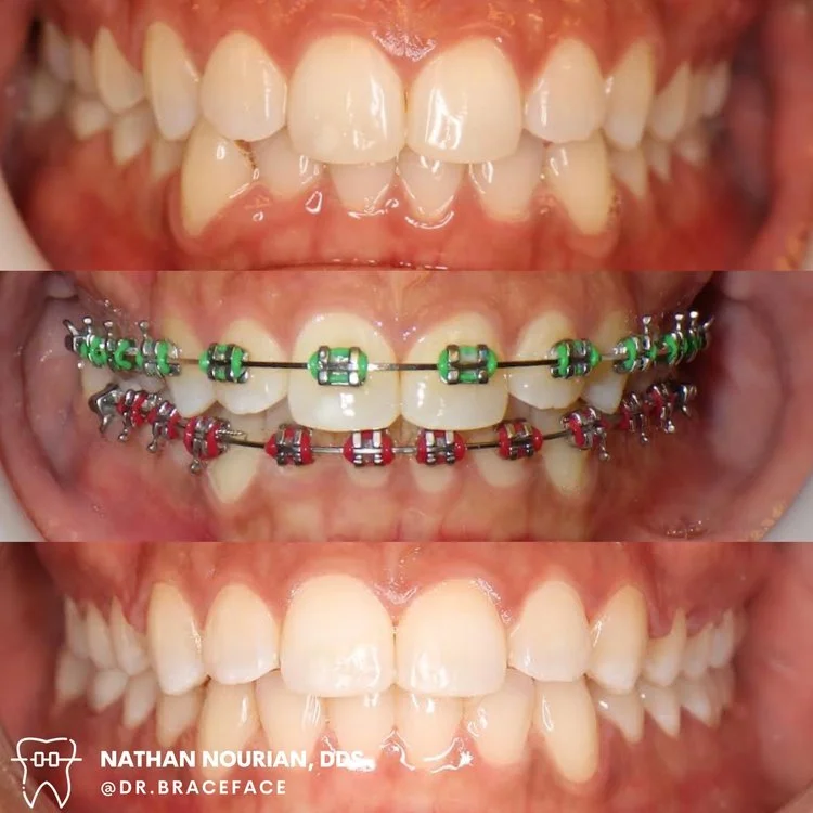 Teeth with braces before and after treatment