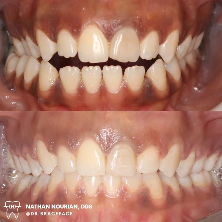 Before and after dental alignment of teeth.