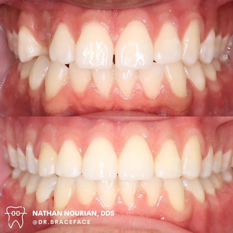Before and after comparison of a dental treatment, showing improved teeth alignment and appearance.