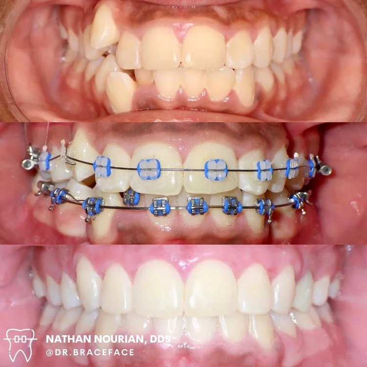 Dental progression with braces treatment.