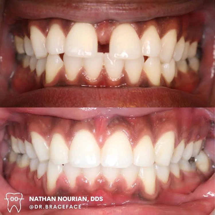 Before and after dental correction showing teeth alignment improvement.