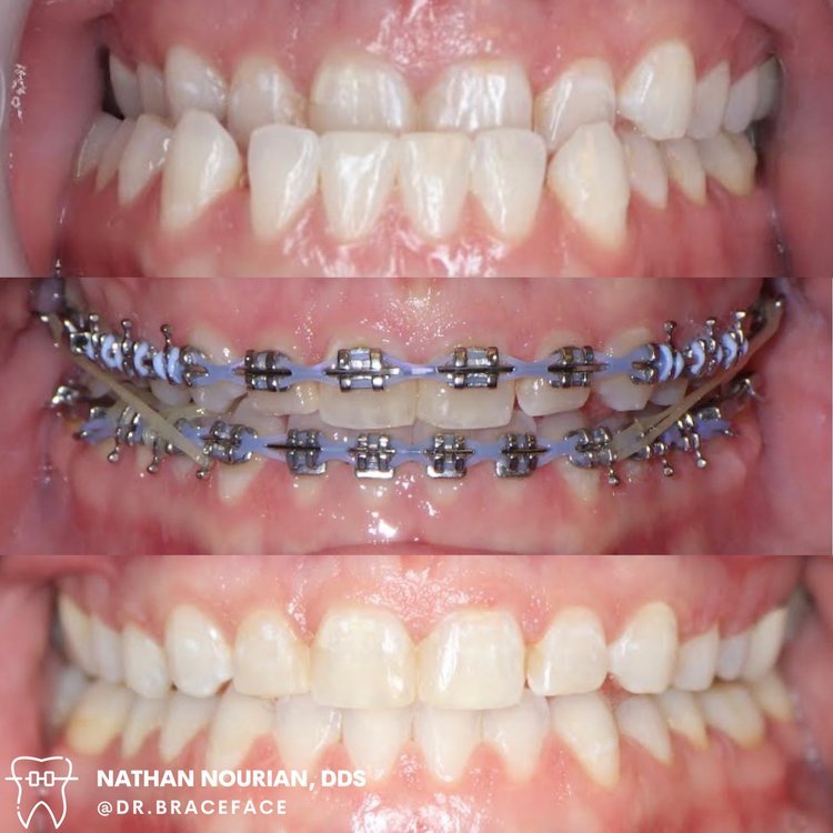 Close-up image showing teeth before, during, and after orthodontic treatment with braces.