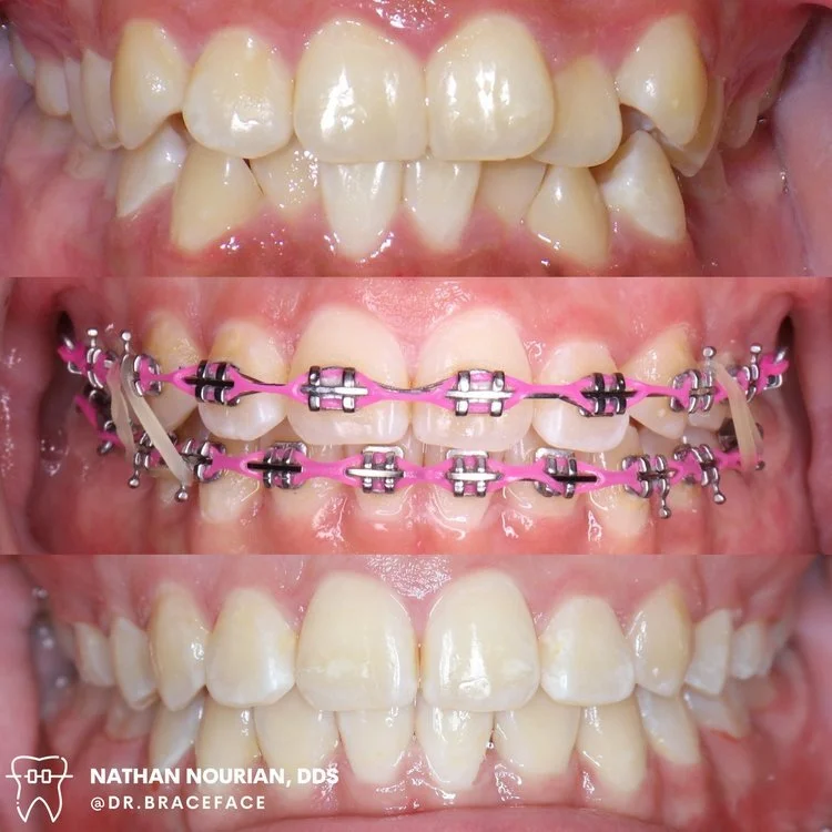 Three-panel image showing teeth before braces, with braces, and after braces treatment.