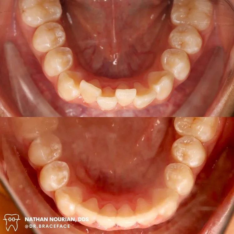 Before and after dental treatment showing lower teeth alignment.