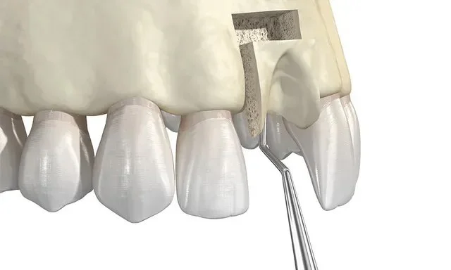 Dental illustration showing sinus lift procedure with bone graft above upper teeth.