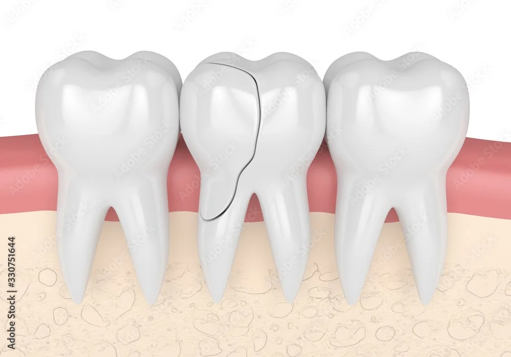 Illustration of a turned wisdom tooth