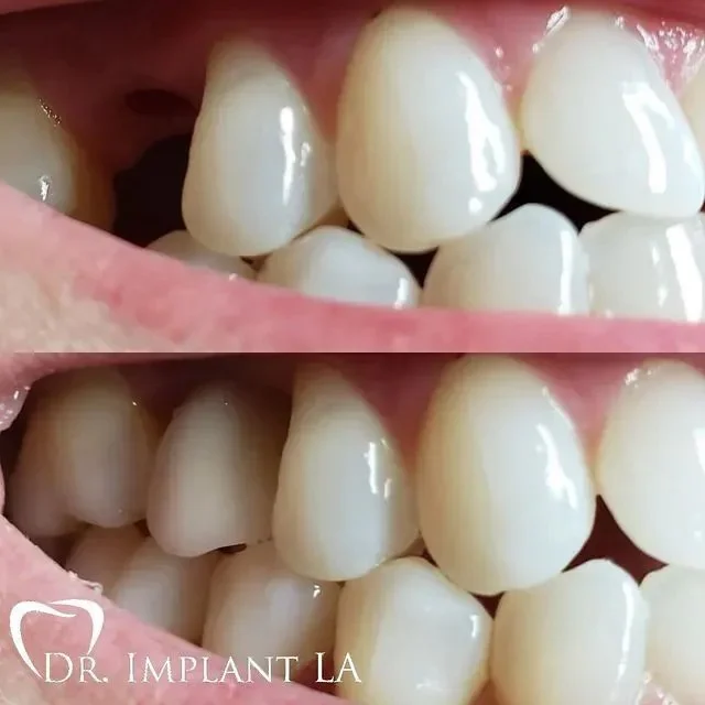 Dental Implants - Sherman Oaks Dentist - Ron Nourian DDS 02.jpg