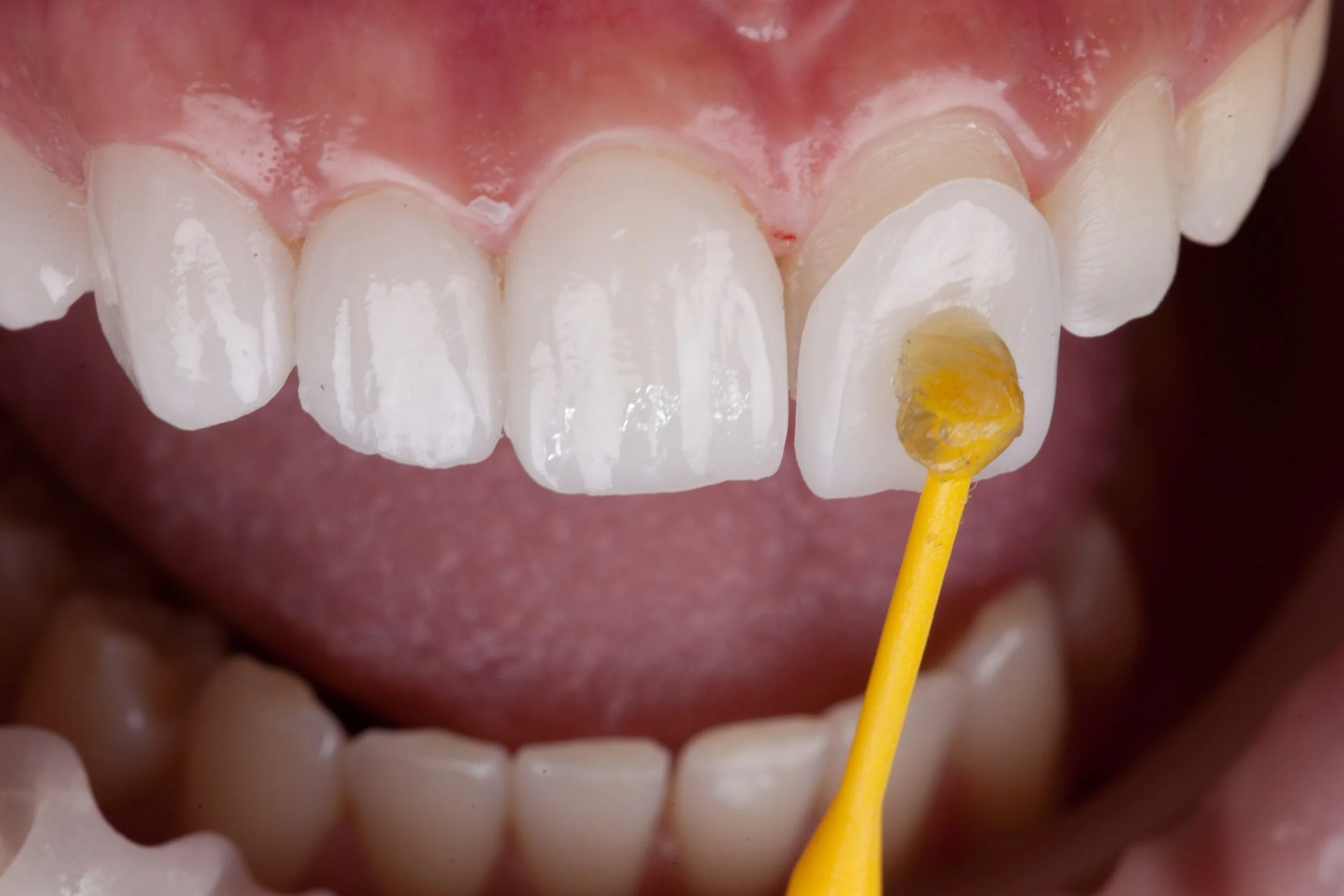Close-up of a person's upper front teeth with a yellow dental instrument applying a coating or sealant on one tooth.