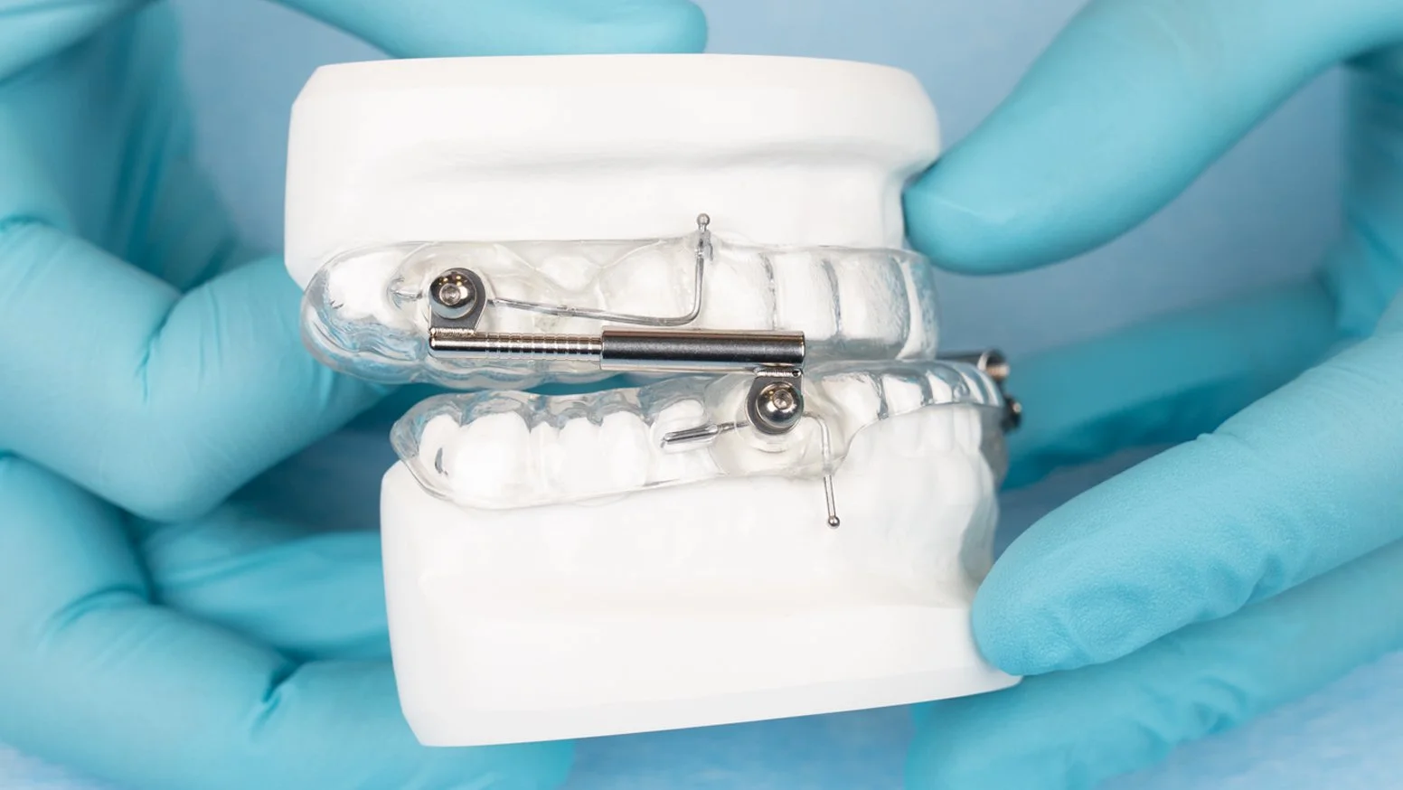 A dental model with braces and orthodontic appliances.