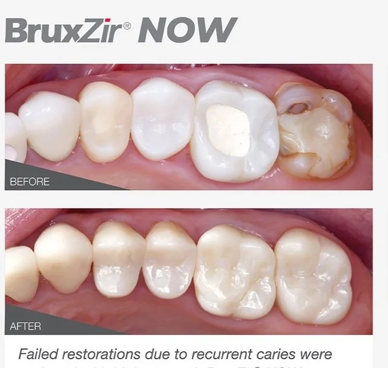 Comparison of dental restorations showing a before and after of a patient's teeth. The top image labeled 'BEFORE' shows a molar with an existing filling and decay, while the bottom image labeled 'AFTER' shows the same tooth restored with a new filling. The text indicates that the restoration was successful after previous failed attempts.