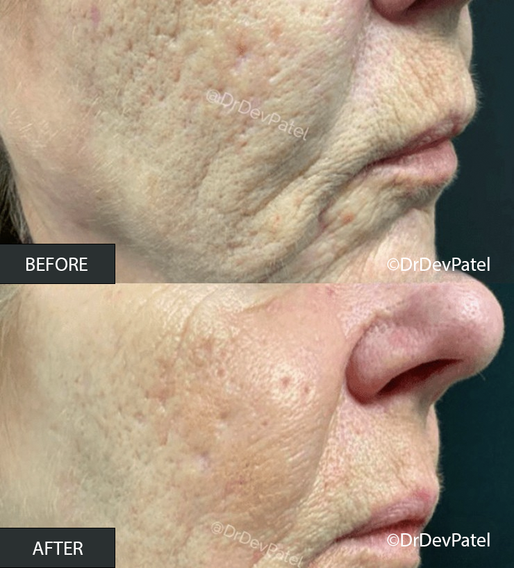 Close-up comparison of skin on a person's cheek and nose showing significant improvement in skin texture and clarity after treatment, with the 'before' image showing rough, uneven skin and the 'after' image showing smoother, clearer skin.