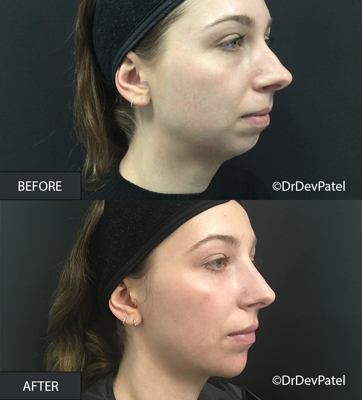 Side-by-side comparison of a woman's face before and after skincare treatment, showing clearer and smoother skin in the after image.