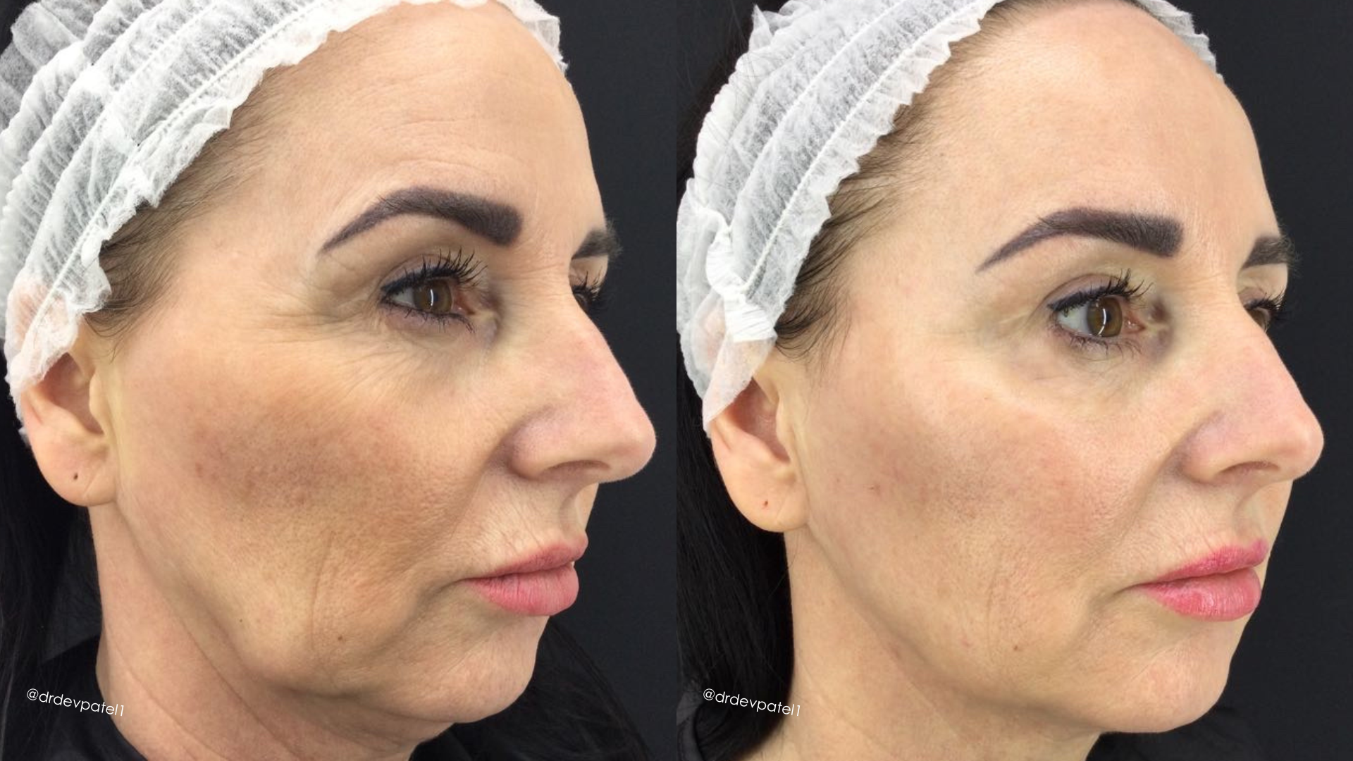 Before and after images of a woman showing the results of a cosmetic procedure, with the woman wearing a white hair cover, showing her face in profile against a black background.