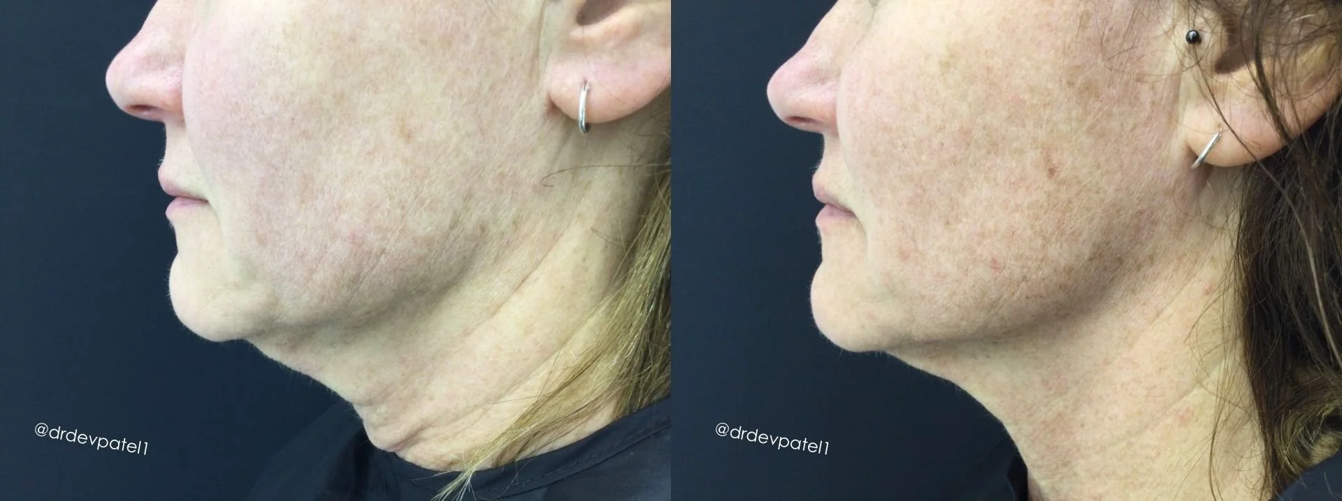 Side-by-side comparison of a woman's face showing skin improvement before and after a treatment, focusing on the jawline and cheek area.