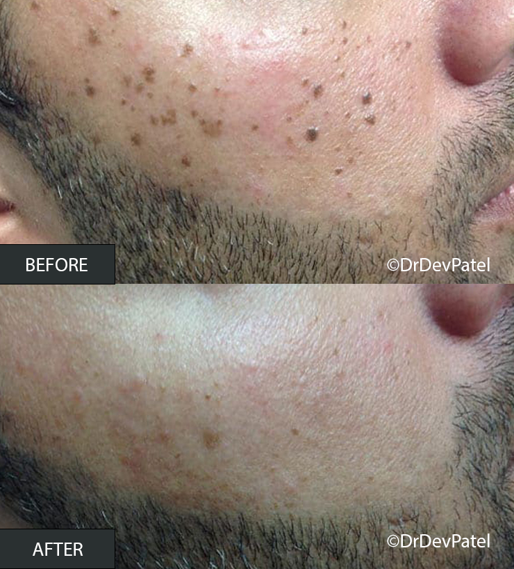 Close-up of a person's lower face, showing a before and after comparison of skin improvement. The before image shows dark spots and acne scars, while the after image shows smoother, clearer skin.