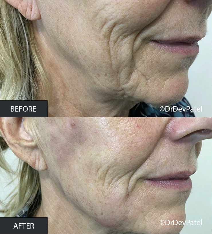 Close-up of a woman's cheek and jawline showing before and after skin treatment, with noticeable improvement in skin texture and reduction of wrinkles in the after photo.