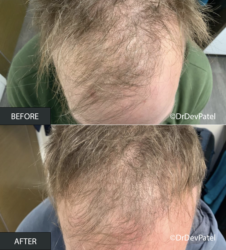 Comparison of a person's scalp before and after hair restoration treatment, showing increased hair density in the after image.