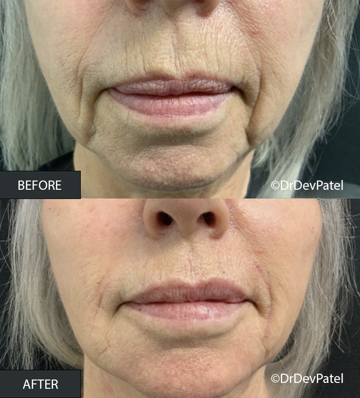 Close-up of a woman's face before and after a cosmetic procedure showing improvement in skin texture and wrinkles around the mouth.
