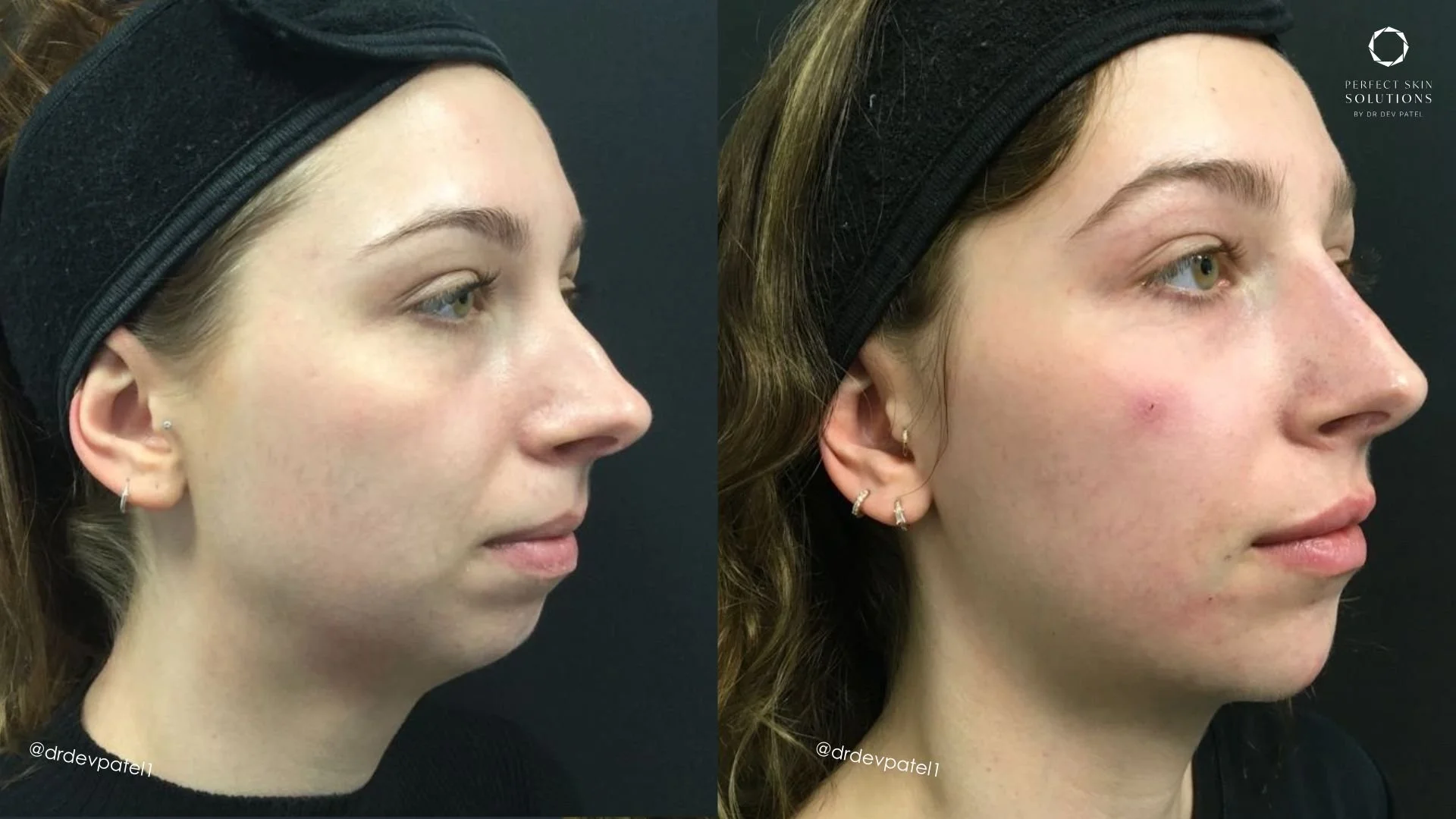 Before and after photos of a young woman showing improved skin clarity and texture, indicating a skincare or cosmetic treatment.