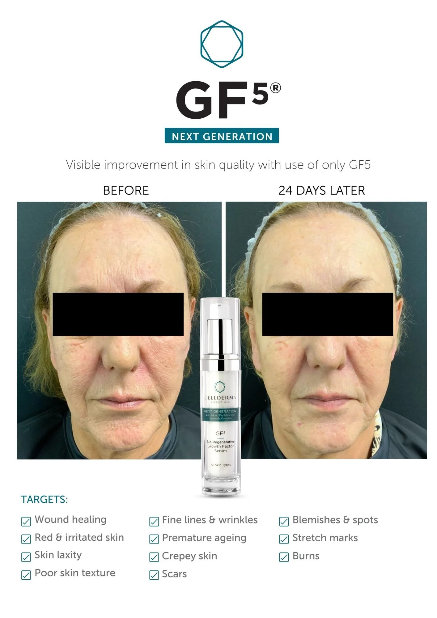 Before and after images of a woman's face showing skin improvement after using a skincare product with GF5 serum. The images show reduced wrinkles, blemishes, and spots, with smoother skin.
