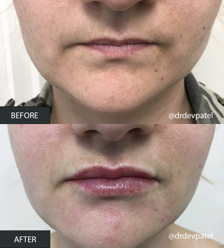 dermal fillers before and after.png
