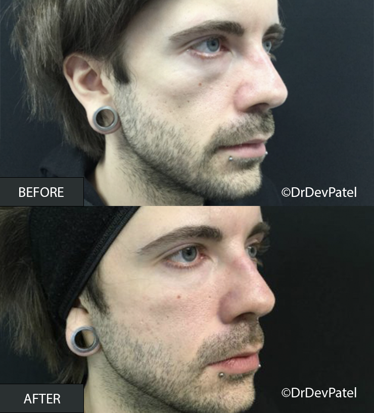 Side-by-side comparison of a man before and after a cosmetic facial procedure, showing smoother skin and refined facial features.