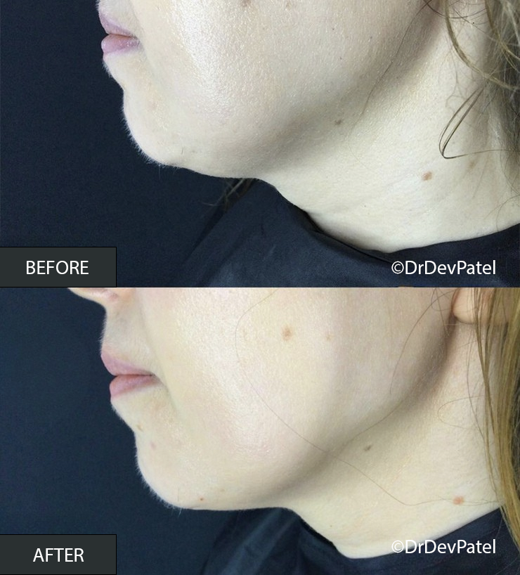 Side-by-side comparison photo showing a person's chin and lower face area before and after a cosmetic treatment, with clearer, smoother skin in the after image.