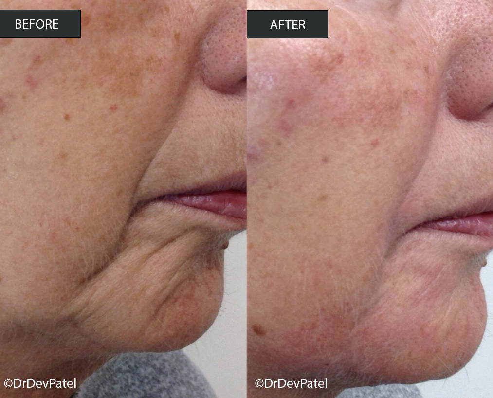 Close-up side view of an elderly person's face showing a before and after comparison of skin condition, with visible improvements in skin texture and reduction of age spots.